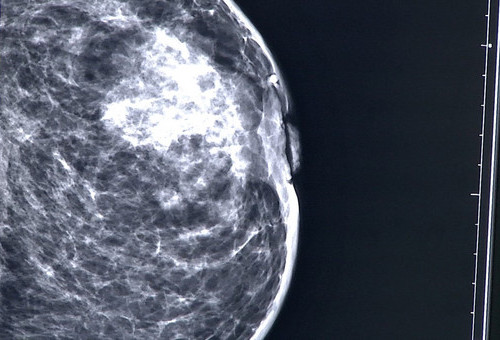 Bezpłatna mammografia
