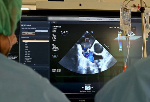 Kardiologiczne przyczyny udarów - profilaktyka